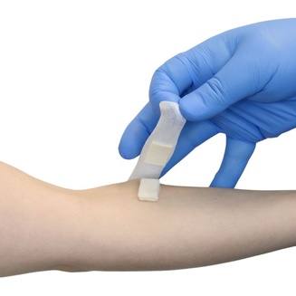 Application of Steriblock Dia compression plasters in combination with Algipad compresses