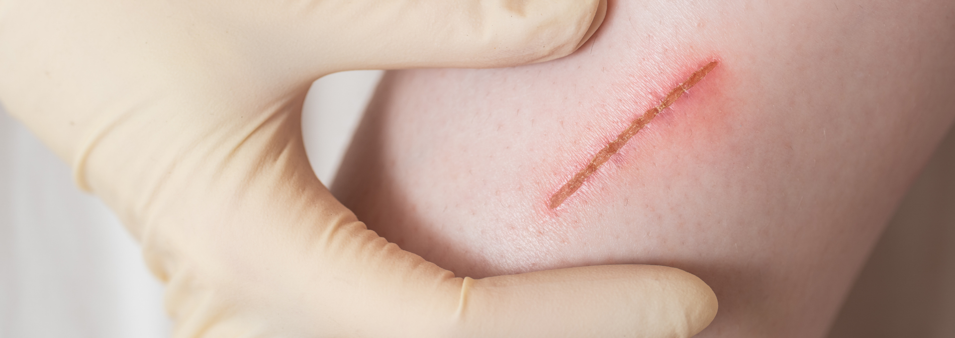 Slider: suture-free wound closure category