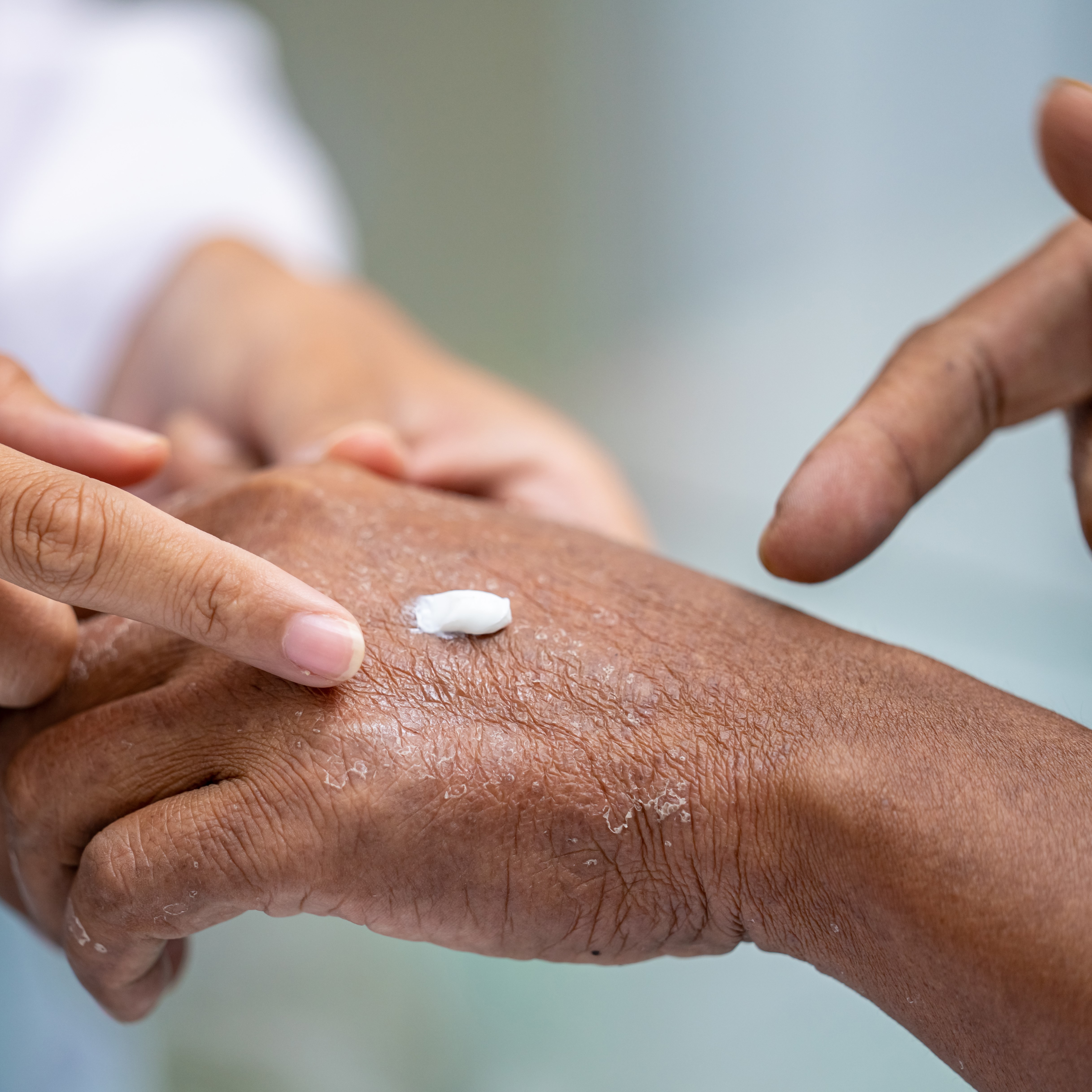 Very dry, cracked skin on hand being treated with a hydrogel